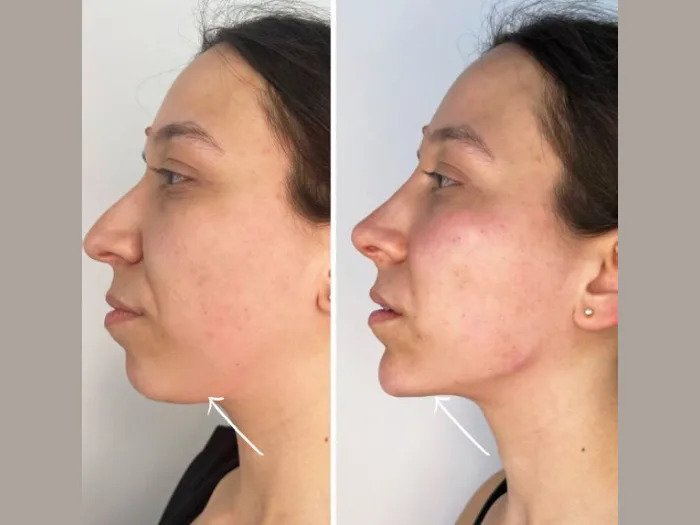 Endolift Excellence by the Best Plastic Surgeon in Dubai