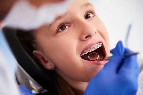 Exploring Teeth With Braces Before and After Changes