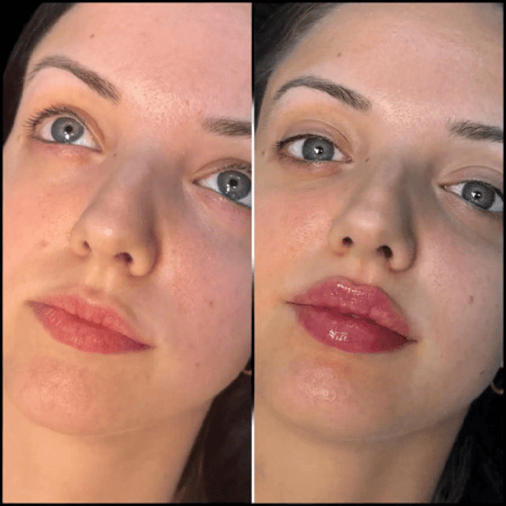 Best Aesthetic Clinic in dubai for Fillers: Popular Trends in Dubai