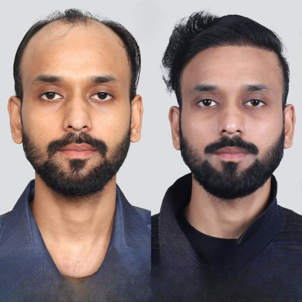 FUT Hair Transplant Procedure in Islamabad: What to Expect