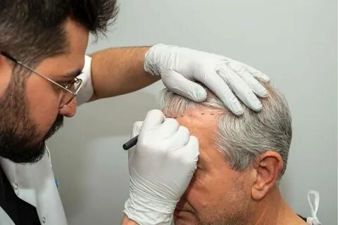 Hair Transplant in Lahore