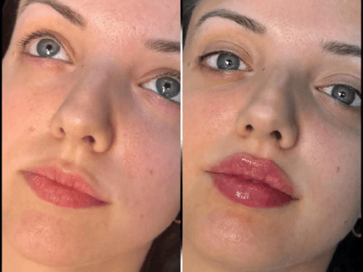 Best Doctors in dubai for Fillers: Balanced Facial Symmetry