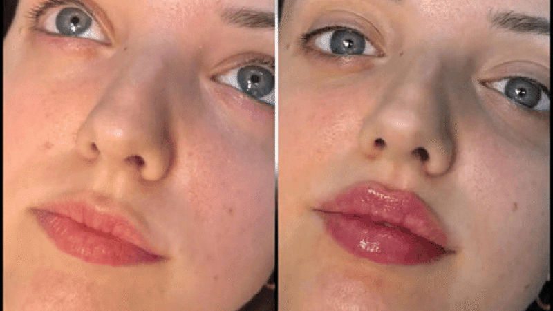 Achieve Subtle Beauty Upgrades with Fillers in Dubai