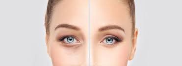 Chirurgie des paupières inférieures à Paris : Retrouvez un regard plus frais
