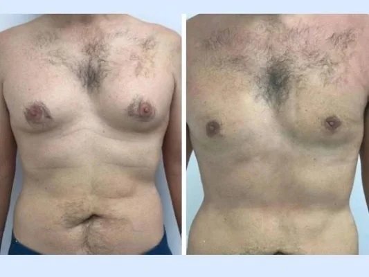 Best Gynecomastia Surgeons in Dubai for Improved Patient Experience