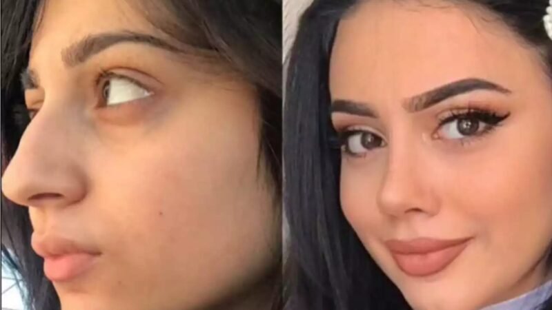 Is Nose Surgery in Dubai Suitable for Different Nose Shapes?