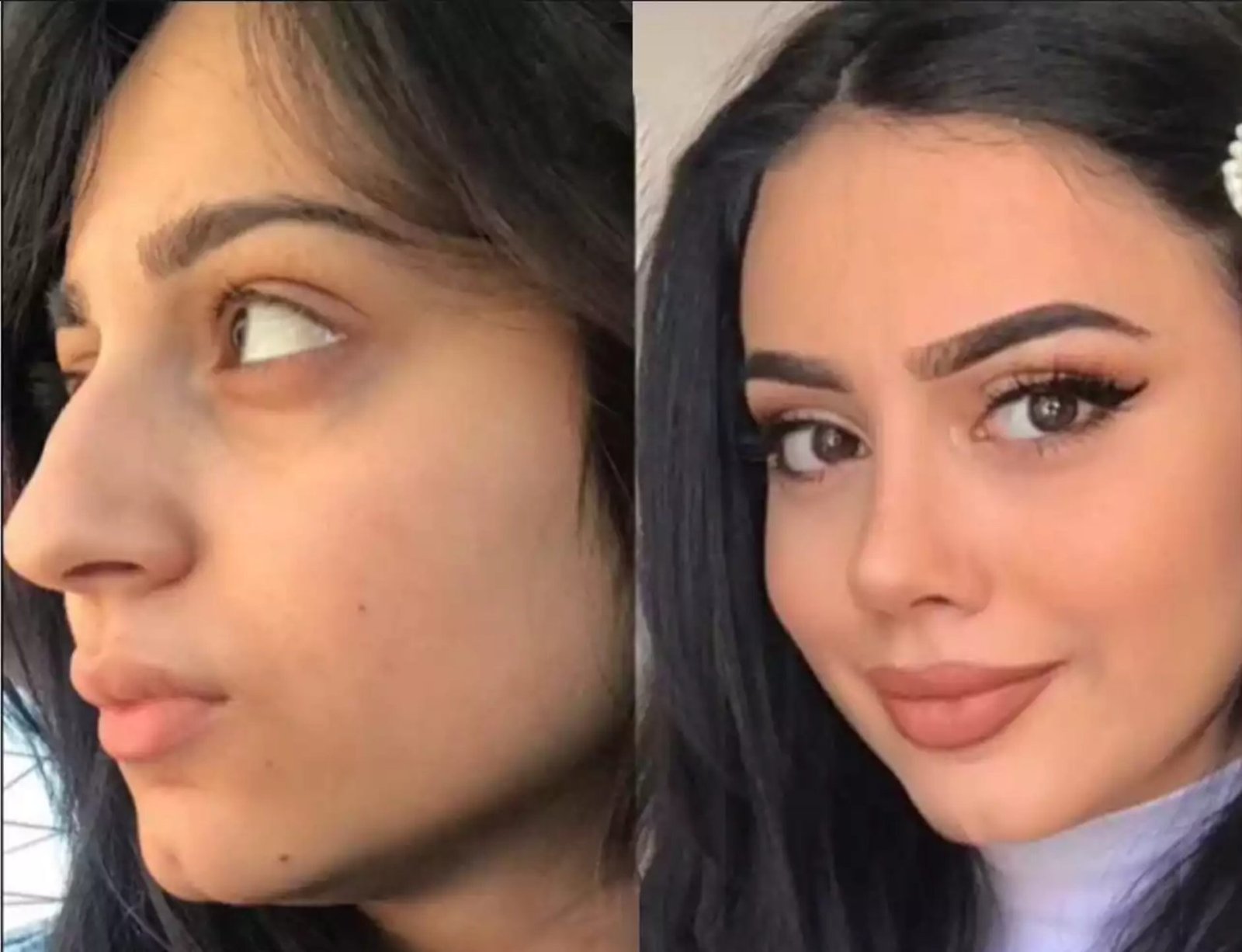 Is Nose Surgery in Dubai Suitable for Different Nose Shapes?