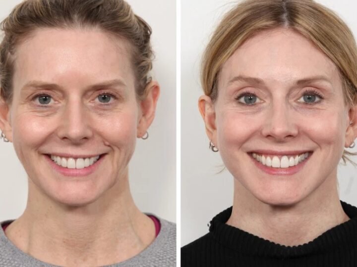 Best Aesthetic Clinic in Dubai for Thread Lift and Skin Tightening