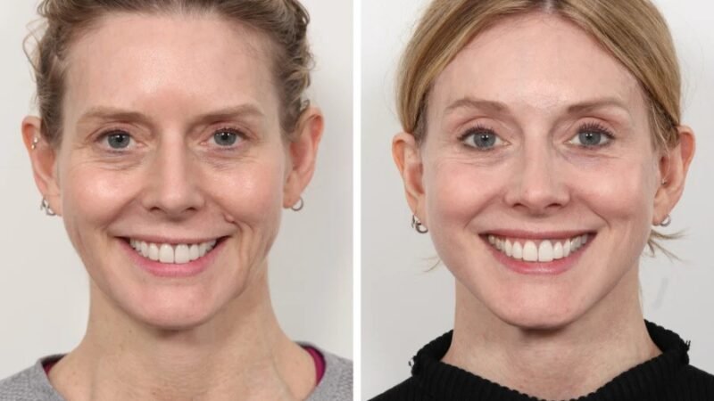 Best Aesthetic Clinic in Dubai for Thread Lift and Skin Tightening
