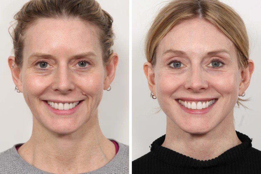 Best Aesthetic Clinic in Dubai for Thread Lift and Skin Tightening
